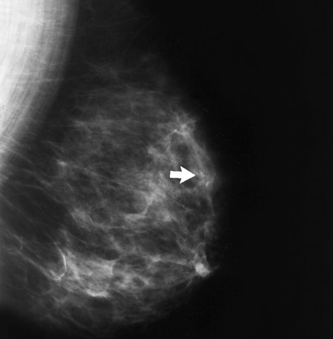 Аденоз на маммографии. Фиброаденома молочной железы маммография. Маммография фиброаденома. Маммография кальцинаты доброкачественные.